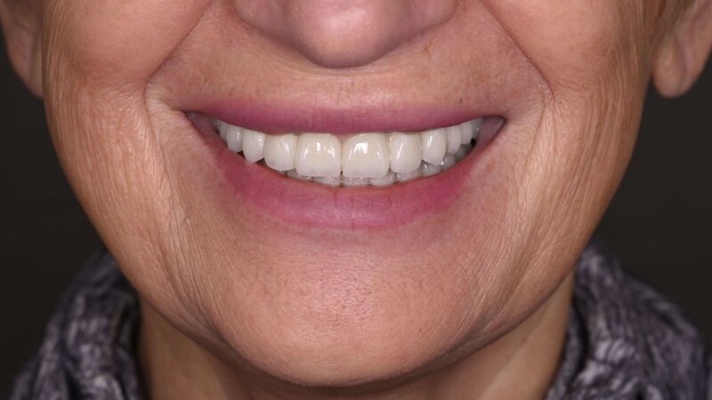 Zâmbet lateral stanga_dupa